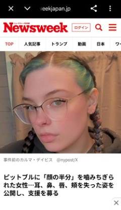 【閲覧注意】てんかん発作で気絶中に飼っていた犬に顔を食べられてしまった女性、現在の顔を公開へ…