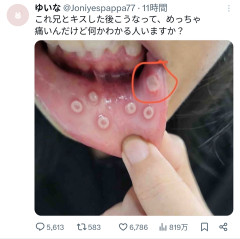 【画像】女の子、実の兄とキスをして口内炎をうつされるｗｗｗｗｗｗｗｗｗ