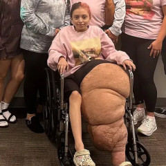 【画像】14歳のアメリカ人少女、手術で約80kgの減量に成功