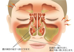 【悲報】蓄膿症、顔の中が膿だらけ