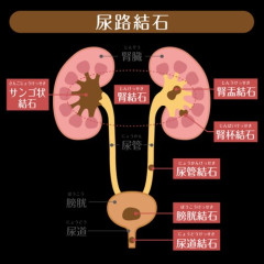 【悲報】尿管結石経験者さん、それよりきつかった痛みを挙げてけｗｗｗｗｗｗｗｗｗｗ