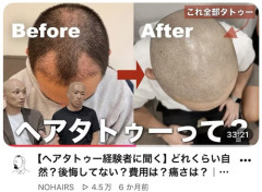 【画像】薄毛男性、タトゥーを入れて完全復活を遂げるｗｗｗｗ
