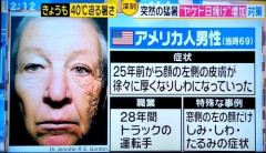 【悲報】男さん、日焼け止めを塗らなかった結果ｗｗｗｗｗｗｗｗｗｗ