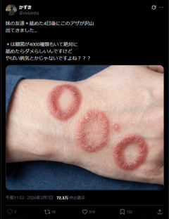 【画像】アレを舐めた男さん、4日後に無事終わるｗｗｗｗ