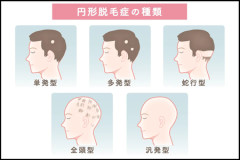 円形脱毛症発症ワイ、退職を決意