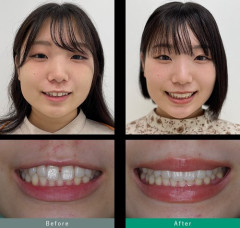 【悲報】日本人さん、歯があまりにも汚すぎる