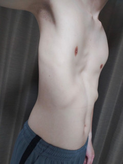 【画像】俺、漏斗胸治っててワロタｗｗｗｗｗｗｗｗｗｗｗｗｗｗｗｗｗｗｗｗｗｗｗ