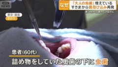 【警告】歯医者『過去に治療した虫歯の再発、急増』