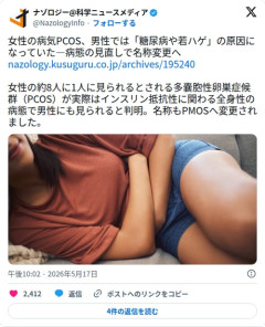【衝撃】女性の病気PCOSさん、実は男性の「若ハゲと糖尿病」の原因でもあったと判明してしまう