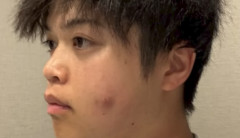 YouTuber「頬にニキビみたいな物ができたから自分で絞るわ！癖になって気持ちいい！」→数ヶ月後、ガチでヤバいことになってしまう・・・