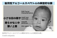【画像】妊娠中の母親が酒を飲んでた赤ん坊の顔ｗｗｗｗｗｗｗｗｗｗｗｗｗｗｗｗ