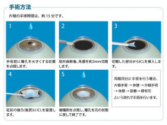 【悲報】ICL眼内コンタクトレンズやったやつおる？ガチで悩んでるんやが・・・・・・・・・