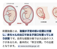 【悲報】妊娠6ヶ月のたぬかなさん、胎盤が子宮口を覆ってしまい出産まで入院し続ける事態に…
