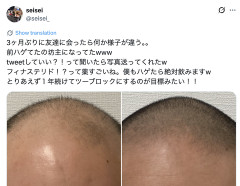 【画像】薄毛男性、ハゲ治療薬を半年飲み続けて無事復活