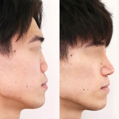 【画像】男の鼻整形、最強だと判明