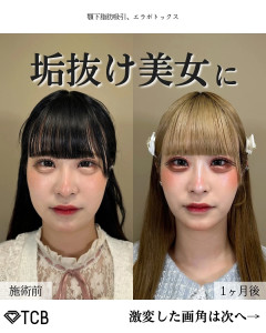 ［朗報］女子、整形で一気に垢抜け爆モテへ…