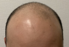 【画像】薄毛男性、ハゲ治療薬を半年飲み続けて無事復活ｗｗｗ