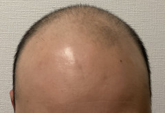 【衝撃】薄毛男性、ハゲ治療薬を半年飲んでこうなる →