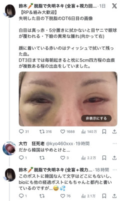 【画像】女さん　整形手術で片目を失明・・・・・
