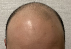 【衝撃】薄毛男性さん、ハゲ治療薬を半年飲み続けて無事復活ｗｗｗｗｗｗｗｗｗｗ