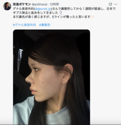 【画像】整形垢さん、無事に鼻の整形に成功してしまう・・・