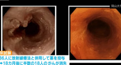 【朗報】食道のがん細胞をウイルスを使って破壊する世界初の治療薬、上野厚生労働大臣が製造販売を承認　薬を投与した結果18ヶ月以内に半数の患者のがんが消失！（動画あり）