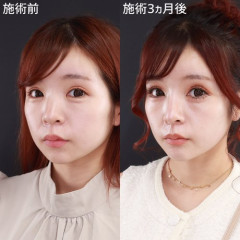 【朗報】整形女さん、無事に鼻の整形に成功して本人も鼻高々ｗｗｗｗｗｗｗｗｗｗ