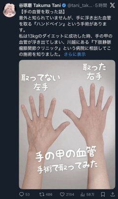 【画像】美容界隈、ついに『血管』除去整形まで流行り始めるｗｗｗｗｗｗｗ