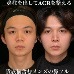 【朗報】女さん、ガチで鼻整形に成功してしまうｗｗｗｗｗｗｗｗｗｗ