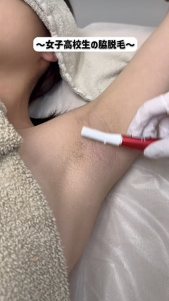 女子高生のワキ脱毛、レベチwww