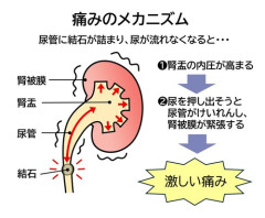 【悲報】お前らさん、尿道結石だけはガチで予防しといた方がいい・・・・・・・・・