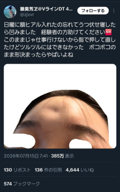【悲報】整形女子さん、突然おでこが凹んでしまう