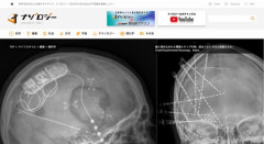 【朗報】うつ病、数分で治ることが判明。脳内に電極を埋め込んで「喜び回路」を刺激