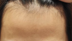 【朗報】ワイМ字ハゲ、毛生え薬1ヶ月でガチ復活wwwwwwwwww