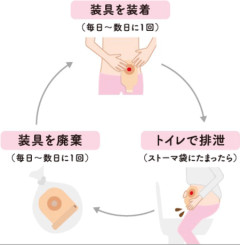 医者「人工肛門を付ける位置はお腹の横でええか」←よくねぇよ
