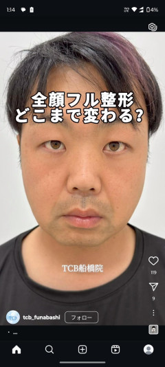 【画像】陰キャ男性さん　整形してイケメンになってしまうｗｗｗ