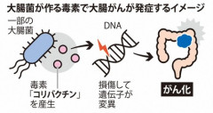 大腸がんの原因が判明　毒素作る腸内細菌が関与
