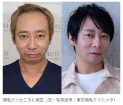 【朗報】「ハゲ」「キモい」で芸能界引退したいしだ壱成さん、植毛で第二の人生へ・・・・・・・・・