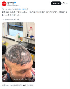 【悲報】植毛を拒否した男、とんでもない方法で髪を手に入れるｗｗｗｗｗ