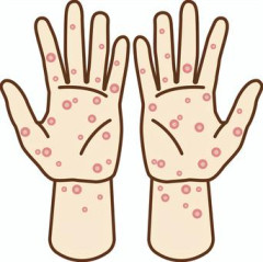 【悲報】梅毒急増中の東京wwwパパ活で病気蔓延か!?
