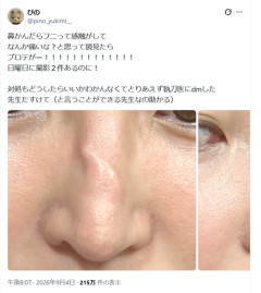 【画像】整形女子、鼻をかんでとんでもない事になってしまうｗｗｗｗ