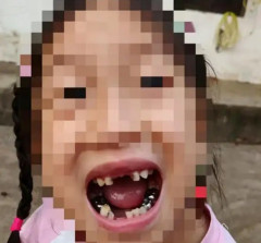 中国製ロボットに蹴られて歯を4本折られた少女、炎症を起こし高熱。顔に傷跡が残り外出を嫌がるようになる・・・