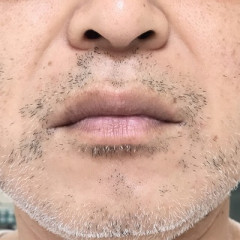 【疑問】未だ「ヒゲ脱毛」をしてない人間の正体ｗｗｗｗｗ
