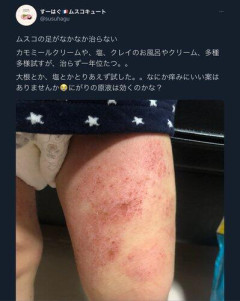 【悲報】自然派ママ「助けて！息子の足が治らないの😭」