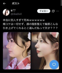 【画像】港区女子「顔の脂肪吸引して垢抜けた～！」パシャパシャ