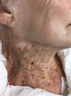 【画像】約40年間、顔にのみ日焼け止めを塗り続けた92歳の婆さんがこちらｗｗｗｗｗｗ