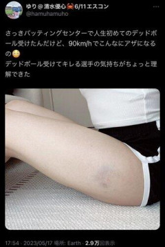 【画像】　女の子「デッドボールは90キロでも太ももにアザできちゃうんだよ？」ﾊﾟｼｬ