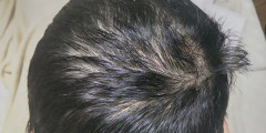 【画像】43歳だがヤバいか？【頭髪】