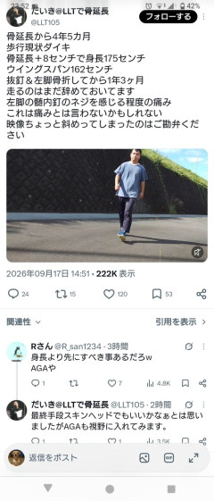 【画像】骨延長で175センチの身長を手に入れた男性、現状を報告するｗｗｗｗｗ