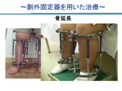 【画像】骨延長で175cmの身長を手に入れた人現る
